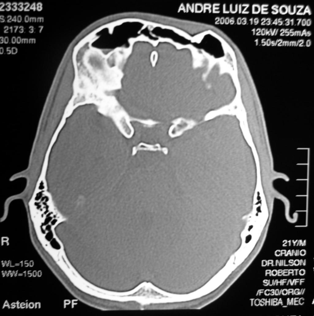 Fratura fronto-naso-órbito-etmoidal Figura 2. Tomografia computadorizada em corte axial. Figura 5. Pós-operatório de um ano em norma frontal. DISCUSSÃO Figura 3.