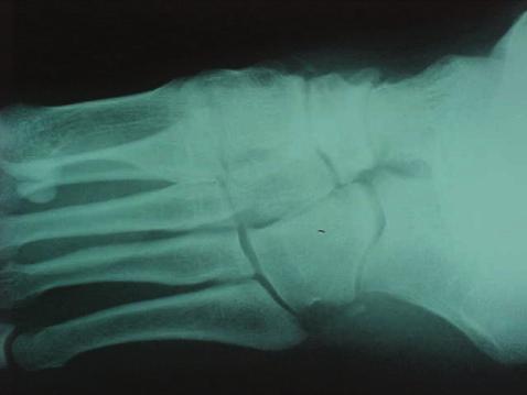 Condroblastoma dos ossos do pé: Aspectos clínicos e radiográficos Tabela 2 - Avaliação funcional do pós-operatório dos pacientes pelo critério de Enneking Nº Paciente Dor Função Aceitação Habilidade