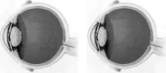d) I, II e III. 21. No processo de visão humana, o cristalino desempenha um papel importante na formação da imagem. Marque a alternativa correta sobre essa estrutura do olho humano.