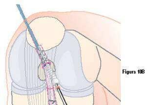 À medida que a perfuração femoral é feita através do portal antero-medial, a colinearidade do parafuso CALAXO de fixação e enxerto é garantida.