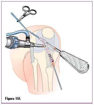 Página 12 Mantendo a tração sobre o enxerto através das suturas distais e proximais, o parafuso CALAXO é avançado (Figura 11A).