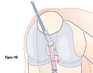 O parafuso CALAXO é avançado até que a cabeça esteja complemente enterrada no túnel femoral, idealmente 5 mm de profundidade na abertura do córtex femoral interno.