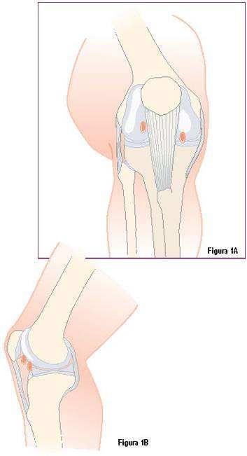 Página 5 Colocação Portal Artroscopia de rotina é realizada antes da reconstrução do ligamento cruzado anterior. Uma colocação portal apropriada é crítica.