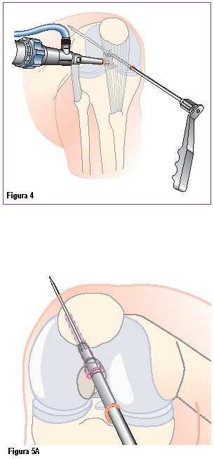 Na extremidade livre, os quatro membros de tendão são suturadas por 40 mm com uma sutura #2 utilizando ponto de baseball corrediço.