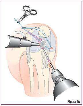 O guia de perfuração é ajustado para fazer um túnel tibial com 45 mm de comprimento que corresponda ao comprimento de 45 mm dos direcionadores de compactação tibial RCI (Figura 7).