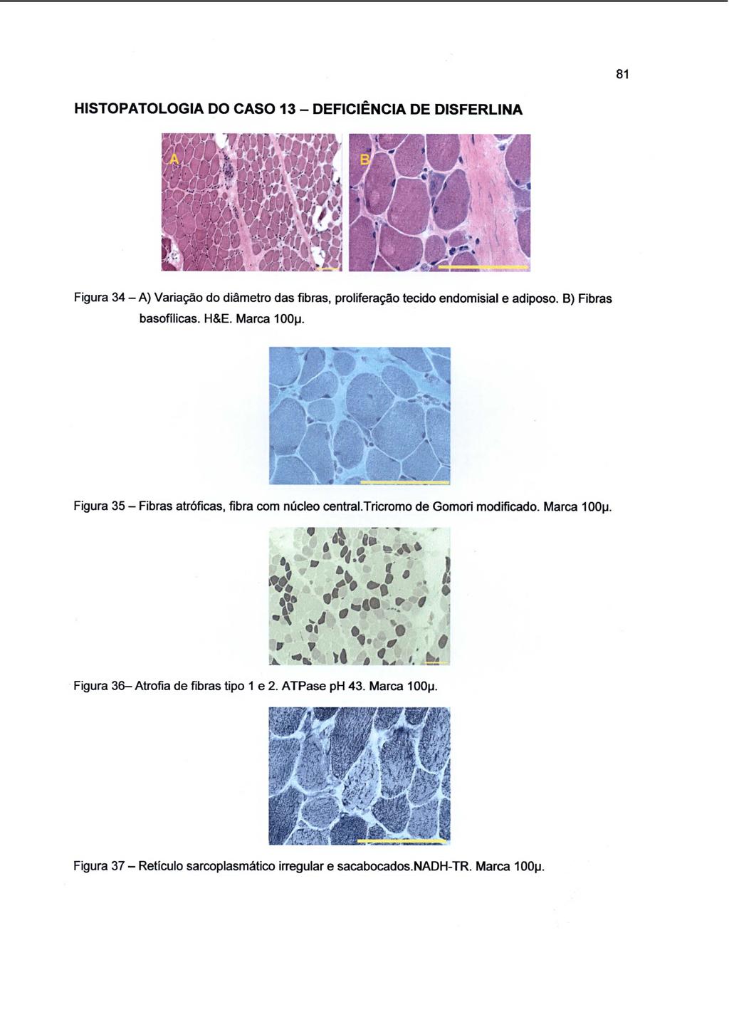 81 HISTOPATOLOGIA DO CASO 13-DEFICIÊNCIA DE DISFERLINA Figura 34 -A) Variação do diâmetro das fibras, proliferação tecido endomisial e adiposo. B) Fibras basofílicas. H&E. Marca 100µ.