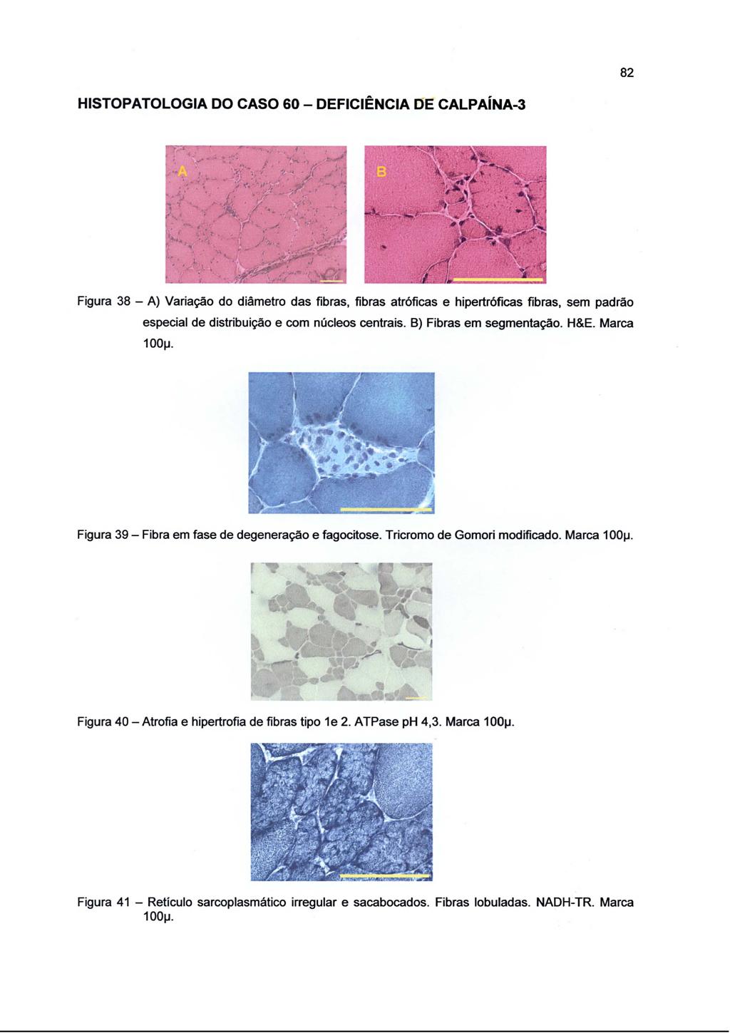 82 HISTOPATOLOGIA DO CASO 60 - DEFICIÊNCIA DE CALPAÍNA-3 Figura 38 - A) Variação do diâmetro das fibras, fibras atróficas e hipertróficas fibras, sem padrão especial de distribuição e com núcleos