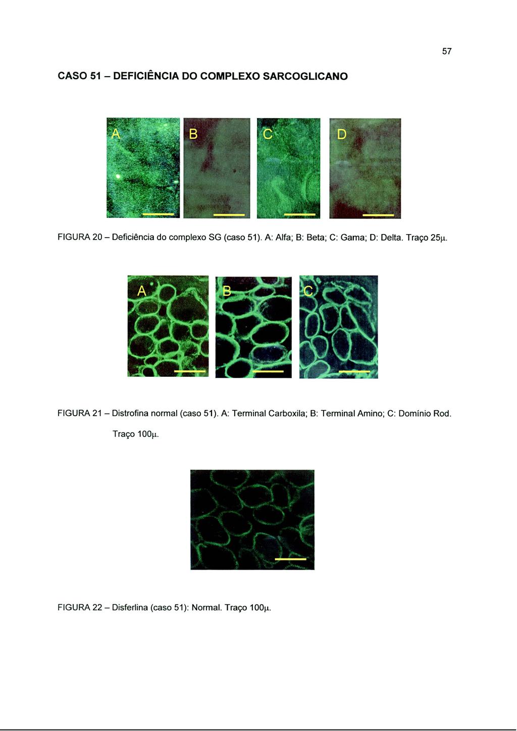 57 CASO 51 - DEFICIÊNCIA DO COMPLEXO SARCOGLICANO FIGURA 20 - Deficiência do complexo SG (caso 51). A: Alfa; B: Beta; C: Gama; D: Delta. Traço 25µ.