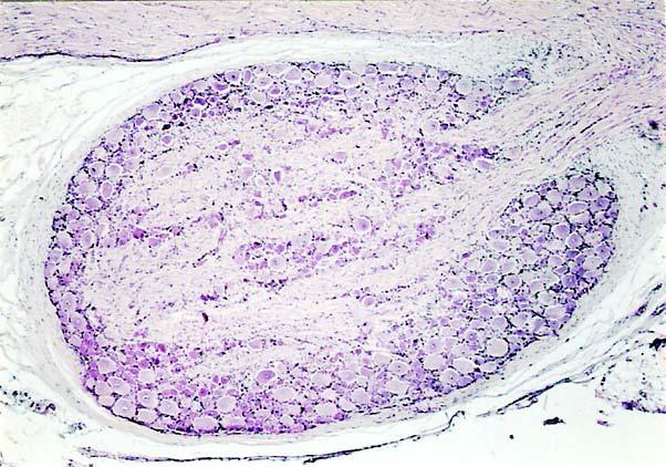 SISTEMA NERVOSO PERIFÉRICO T. Montanari, UFRGS Figura 4.23 - Gânglio sensorial (ou cerebrospinal). Possui uma cápsula de tecido conjuntivo denso não modelado ( ).