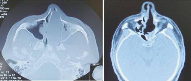 FIGURA 2 Estesioneuroblastoma (pré e pós operatório) TABELA 2 Histologia e localização Patologia Seio envolvido Casuística Papiloma Invertido Etmoidal 1 Maxilar 1 Hemangioma Capilar Fossa nasal 1