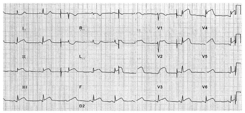 Dissecção espontânea da artéria coronária: resolução angiográfica completa sem colocação de stent 269 irradiando-se para o braço esquerdo e com duração de cerca de 60 minutos.