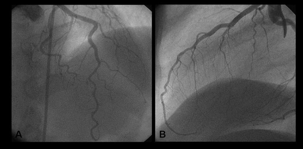 Dissecção espontânea da artéria coronária: resolução angiográfica completa sem colocação de stent 271 Figura 4.