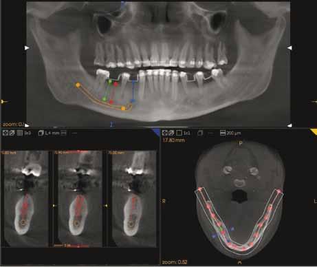 Fig.1.1, 1.2, 1.3, 1.4 - Imagens adquiridas com o CBCT Kodak 9500. a) Volume completo da face que é necessário para a especialidade de ortodontia e cirurgia maxilo-facial.