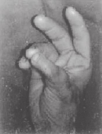 Final aspect after thumb reconstruction with the second toe transfer to the hand (B). Fig. 4 Aspecto final pós-reconstrução do polegar com o segundo dedo do pé (A).