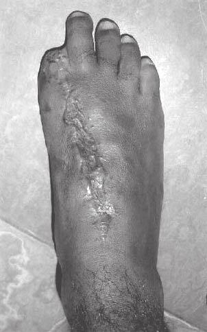 cabeça metatarsal (figuras 5A e 5B). Fig. 5 Aspecto final da área doadora do pé pós-retirada do segundo dedo do pé (A).