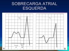 Sobrecarga do átrio esquerdo (SAE) Onda P com duração > 2,5 quadradinhos Sinal de Morris: em V1, a porção negativa da onda P tem > 1 quadradinho de amplitude e de duração Sobrecarga de