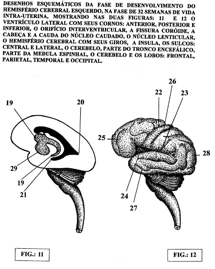 DESENHOS ESQUEMÁTICOS, DAS FASES DE DESENVOLVIMENTO DO HEMISFÉRIO CEREBRAL ( LADO ESQUERDO ), NA FASE DE 32 SEMANAS DA VIDA INTRA-UTERINA, MOSTRANDO, NAS DUAS FIGURAS ( 11 E 12 ) O VENTRÍCULO