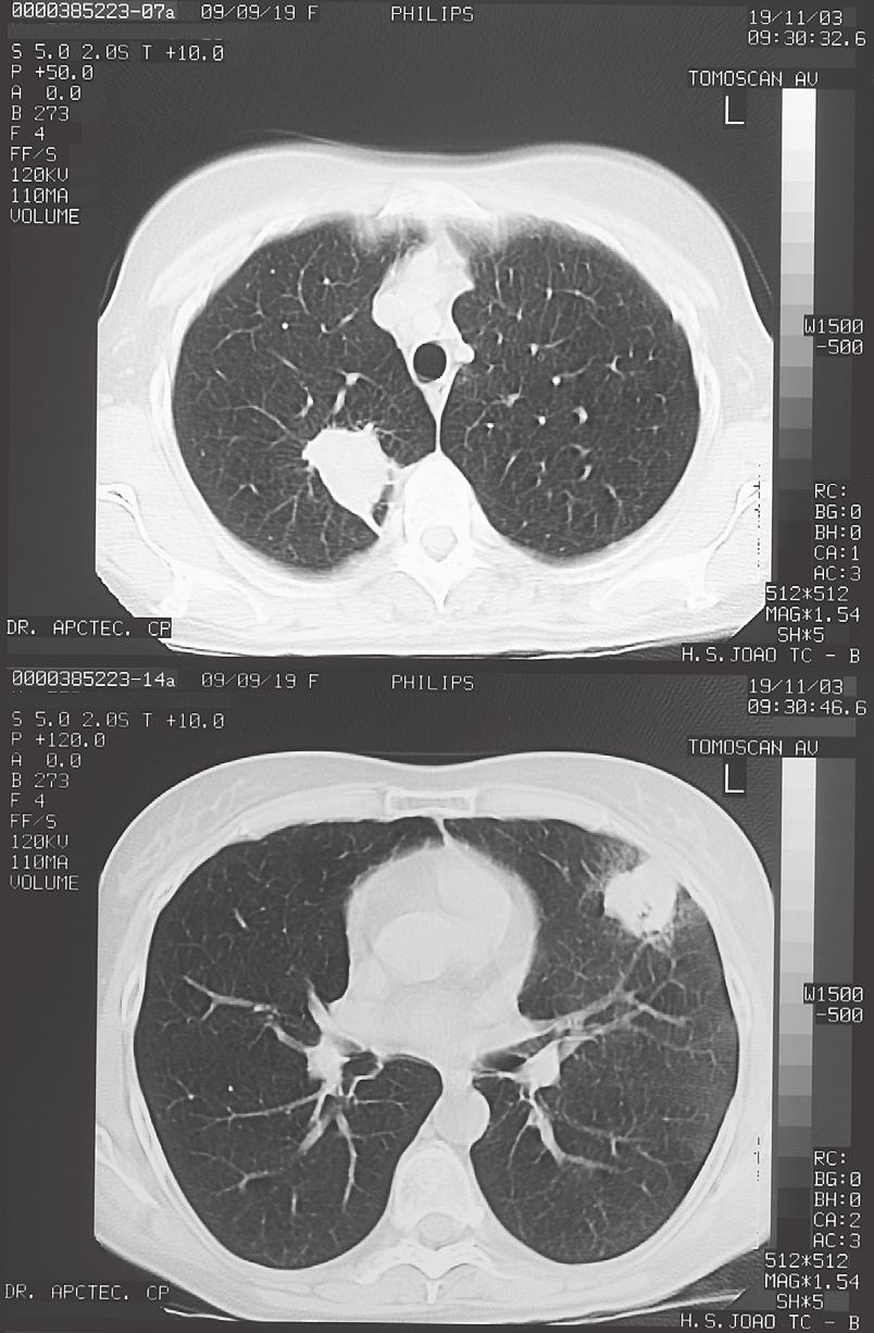 Fig. 3 (04-2004) Radiological re-evaluation showing significant reduction of the right lesion Figs.