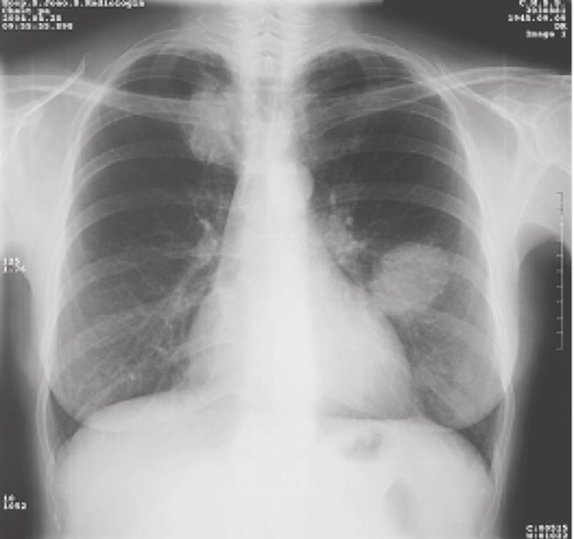 Six months after beginning treatment, radiological evaluation revealed a reduction of the right lesion (Fig.