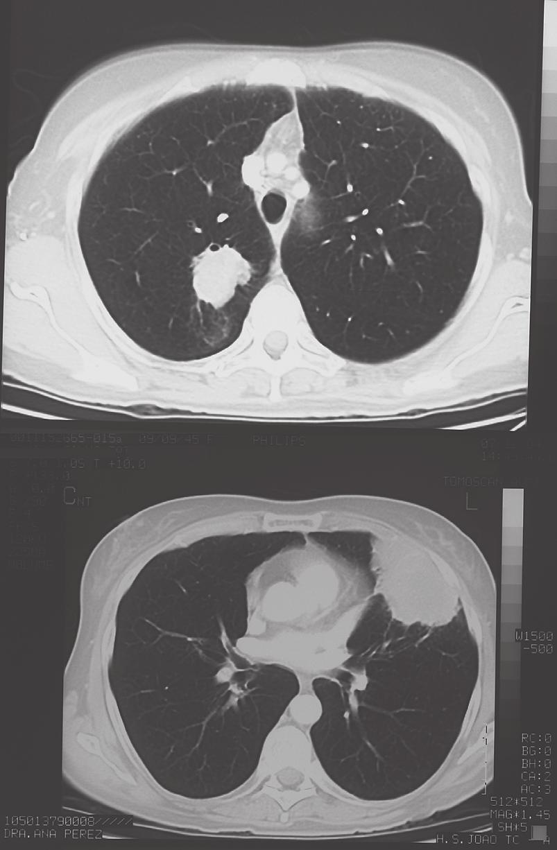 3 and 4), with a total absence of response to treatment. We decided to perform a further TFNA of the left lingula lobe lesion.