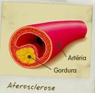 DOENÇAS CARDIOVASCULARES Arteriosclerose: Endurecimento, espessamento e diminuição da elasticidade das artérias.