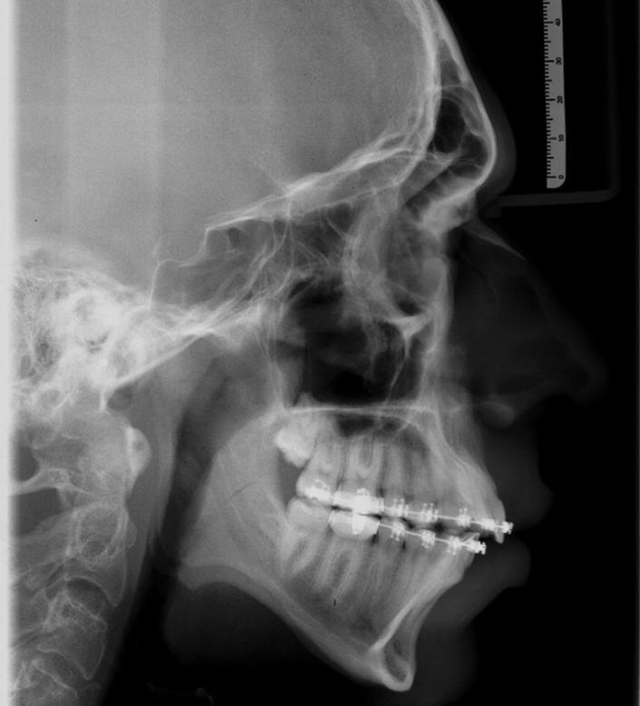 diagnosticados com anomalias dento-faciais esqueléticas e indicados para tratamento por meio de cirurgia ortognática de maxila e/ou mandíbula.