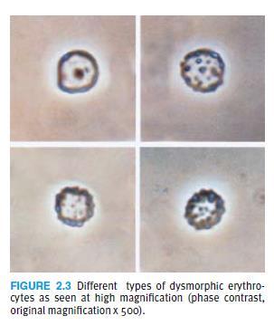Eritrócitos dismórficos com mesmo tipo de característica