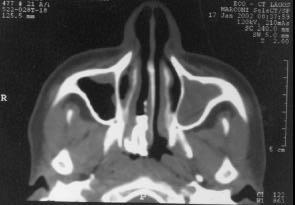 unilateralidade dos rinólitos a alterações anatômicas locais (desvio septal, hipertrofia de cornetos, formato
