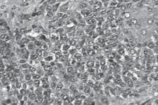 Pulmão RJ vol.14(2) 2005 intensa positividade em membrana celular, o que confere diagnóstico para linhagem B das células neoplásicas (Figura 6).