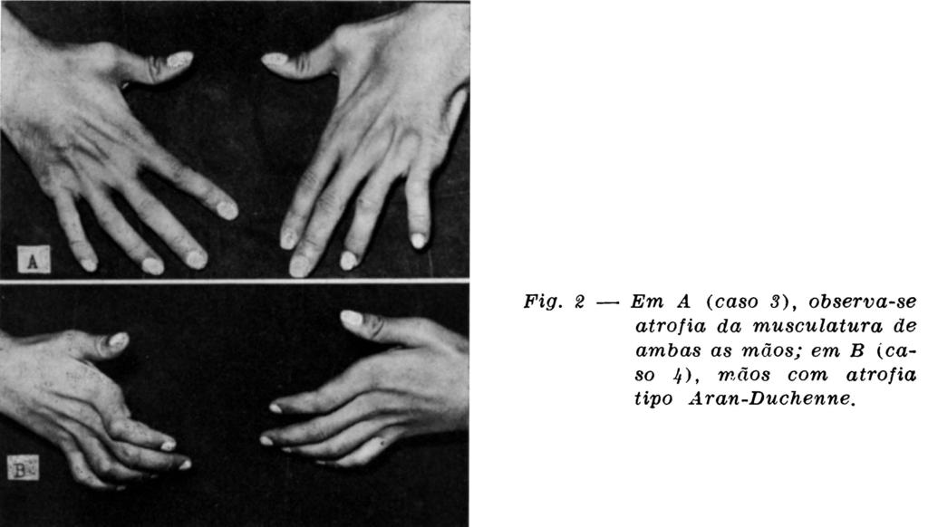 São conhecidas, entre outras, as formas pareto-amiotróficas da acropatia úlcero-mutilante, formas de transição da moléstia de Charcot- Marie-Tooth e a neurite intersticial de Déjerine-Sottas, formas