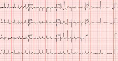 Apresentação Caso Clínico #2 QUIZZ ONLINE: QUE ARRITMIA ESTÁ PRESENTE NESTE CASO? 1. Extrassistolia ventricular frequente 2. Flutter auricular 3. Taquicardia supraventricular 4.