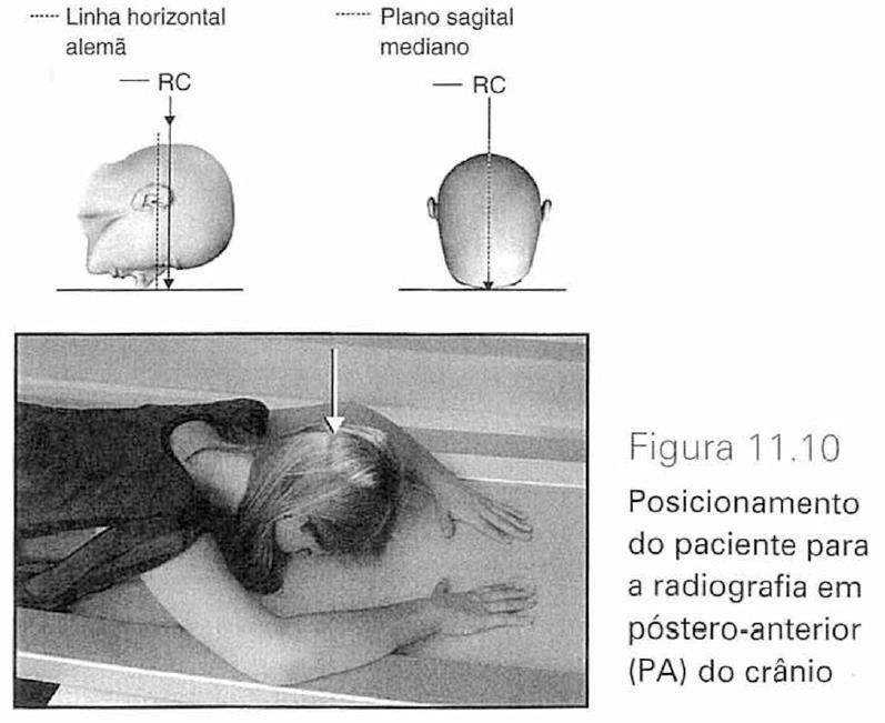 Incidências e posicionamentos para o estudo radiográfico do crânio Póstero-anterior (PA) Também denominada incidência de Caldwell, occipito-frontal, ou PA verdadeiro do crânio, é usada na rotina do