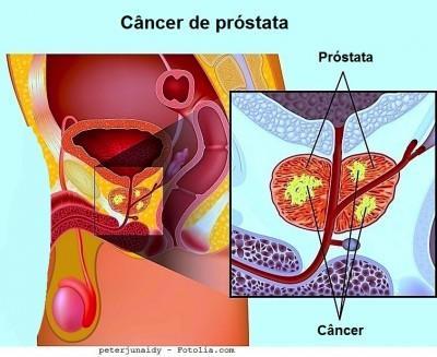 Alguns especialistas acreditam que o câncer de próstata começa com pequenas mudanças no tamanho e forma das células das glândulas da próstata.