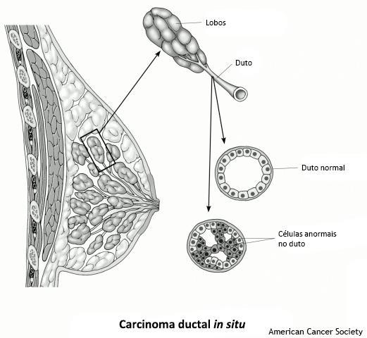 Cerca de 20% dos novos casos de câncer de mama serão de carcinoma ductal in situ. Quase todas as mulheres diagnosticadas neste estágio da doença podem ser curadas.