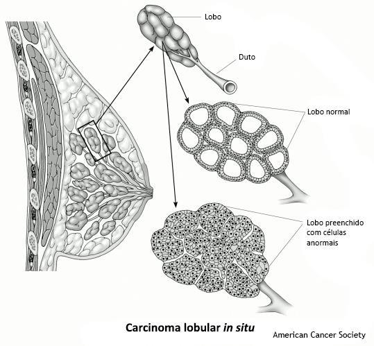 Carcinoma Ductal Invasivo Este é o tipo mais comum de câncer de mama.