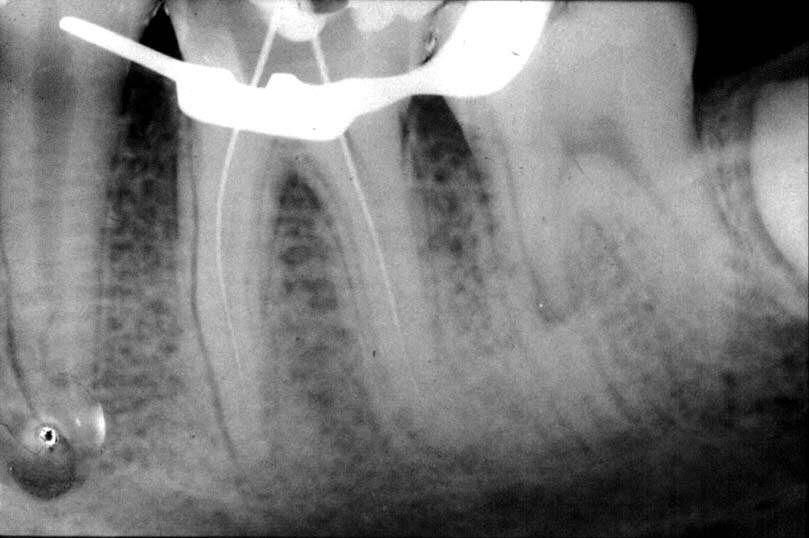 Rev. ABO Nac.4 Fig. 1-A (Caso 1) - Lima tipo K n o 10 no canal MV de um primeiro molar inferior esquerdo.