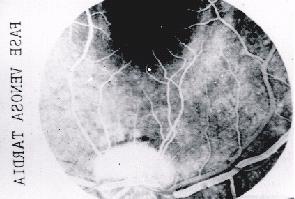 Figura 6: Angiofluoresceinografia: Fase Venosa Tardia Figura 4: Angiofluoresceinografia: Fase Venosa Precoce A fase final é a tecidual e se notam por retrofluorescência, as estruturas