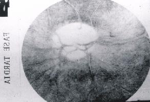 A papila fluoresce através dos ramos capilares profundos e apresenta fluorescência mais intensa que o restante do fundo, permanecendo até a fase tecidual.