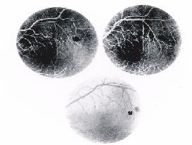 tenham retinopatia.