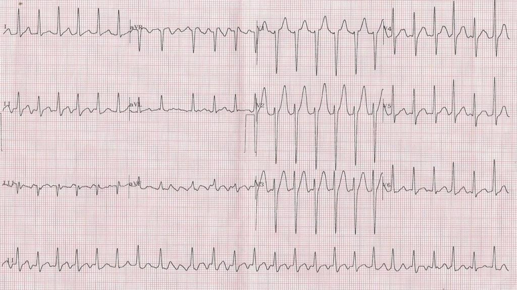outros exames, tais como: Ecocardiograma, que revelou ausência de alteração e o Holter que mostrou Frequência Cardíaca mínima=37, Média=68, Máxima=114, ExtrassistolesVentriculares=9,