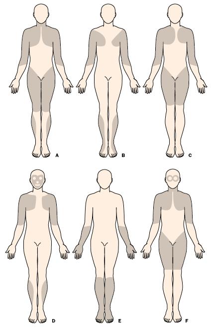 Figura 2 Distribuição predominante da fraqueza muscular em diferentes tipos de distrofias.