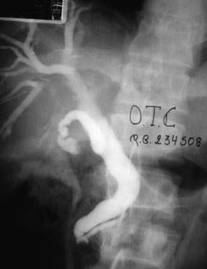 refluxo de bile para o ducto pancreático