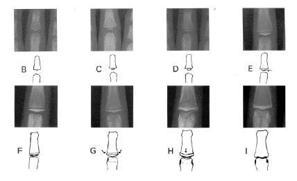 34 A figura 3.4 apresenta um conjunto de imagens que mostra os estágios de desenvolvimento de um osso de B a I.
