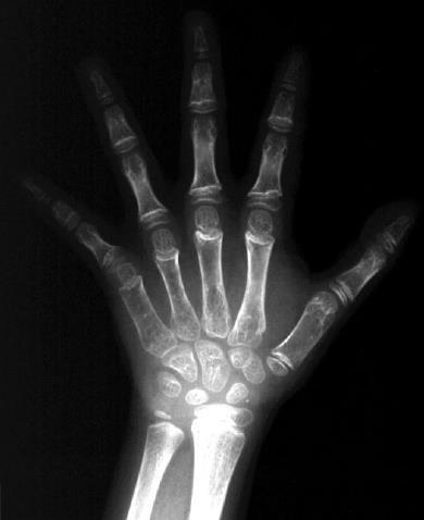 84 polegar (dedo I) e mínimo (dedo V), identificou-se que a causa dos erros em ambos os dedos foi a mesma, interferência de outros dedos, onde deveria estar apenas o respectivo dedo (mínimo ou