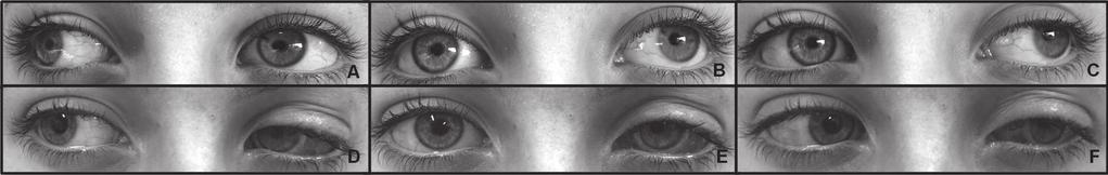 Figura 1 Fotografias do paciente 2 no pré-operatório em dextroversão (A), posição primária do olhar (B) e levoversão (C), e no pós-operatório inicial em dextroversão (D), posição primária do olhar