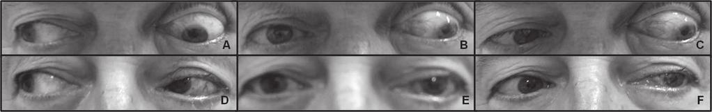 Figura 2 Fotografias do paciente 4 no pré-operatório em dextroversão (A), posição primária do olhar (B) e levoversão (C), e no pós-operatório em dextroversão (D), posição primária do olhar  Figura 3