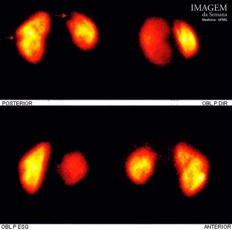 Imagem da Semana: Cintilografia Renal c/99mtc Imagem 01.
