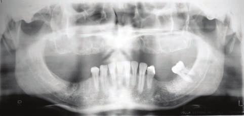 Importância do reconhecimento da anatomia radiográfica dentomaxilar na prevenção de complicações cirúrgicas Tabela 1 - Casos estudados, localização,radiografias utilizadas: PN (Panorâmica); PP