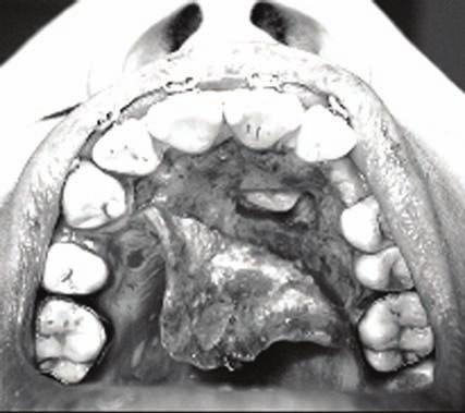 O reparo anatômico na mandíbula mais importante por sua proximidade com dos dentes não irrompidos e ápices radiculares é o canal mandibular, pois o nervo alveolar inferior, quando lesado, pode