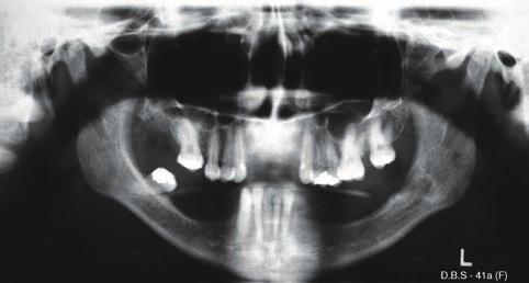 uma parestesia inevitável. Quando há lesão do nervo, em apenas 1% dos casos a sensibilidade é restabelecida 16. Figura 3A - Imagem do dente13 retido na radiografia panorâmica.